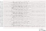 eeg.jpg